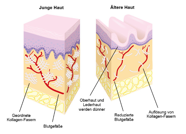 Hautalterung durch UV-Strahlen